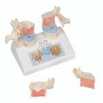 Osteoporosis Model Premium